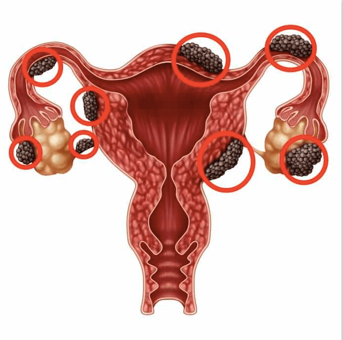 Include endometriosis care in SHA, experts and survivors say