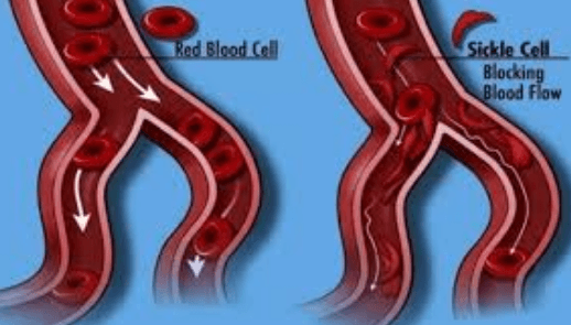 Group wants sickle cell declared a public health emergency in Kisumu