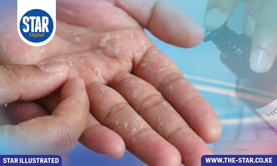 How to treat skin peeling