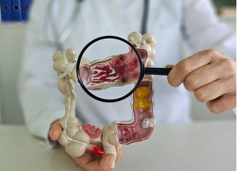 Scientists reveal cause of colon cancer in young people