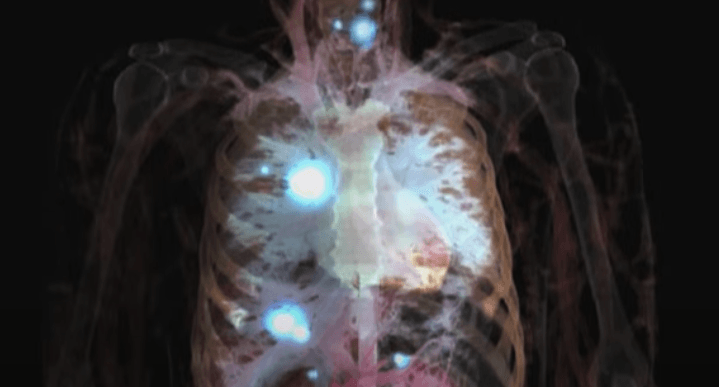 Promising cancer treatments trigger serious side effects - research
