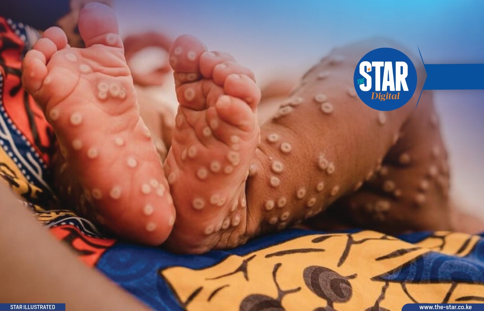 Top 10 counties with the highest Mpox cases in Kenya