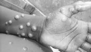 Mpox hotspot: Mombasa tops county case list