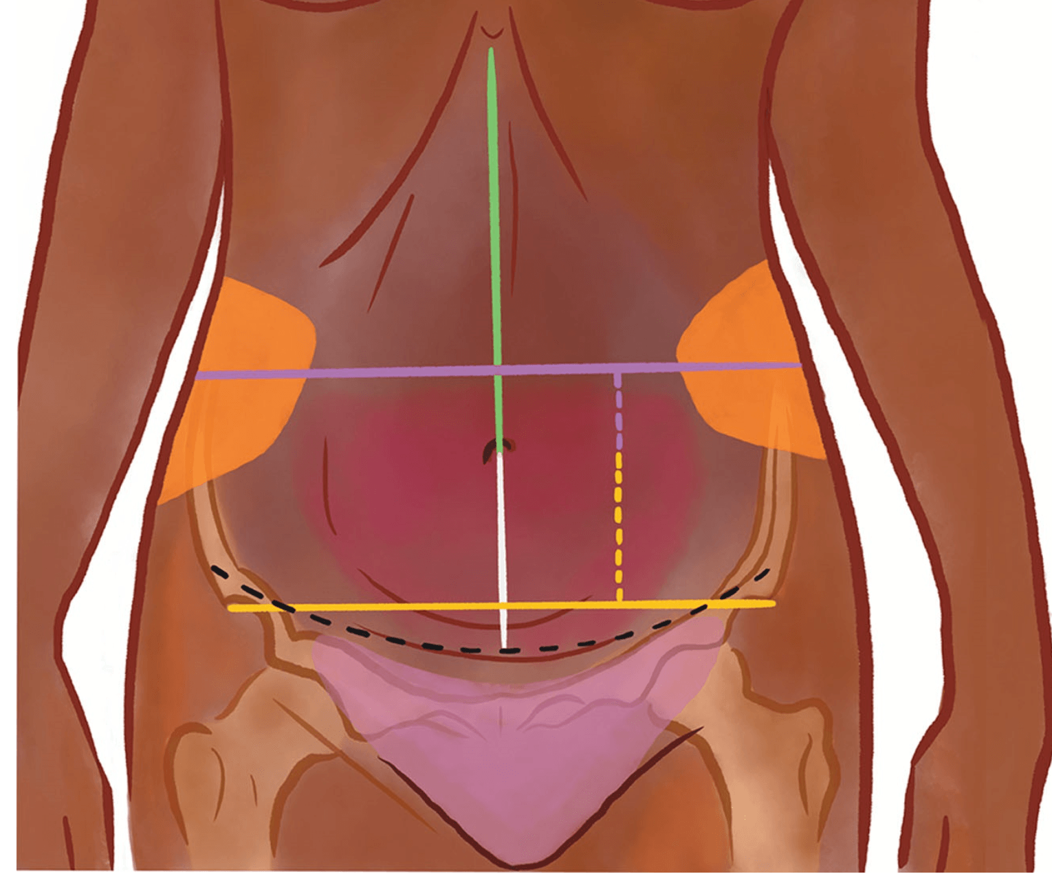 Kenyan belly buttons differ from global patterns