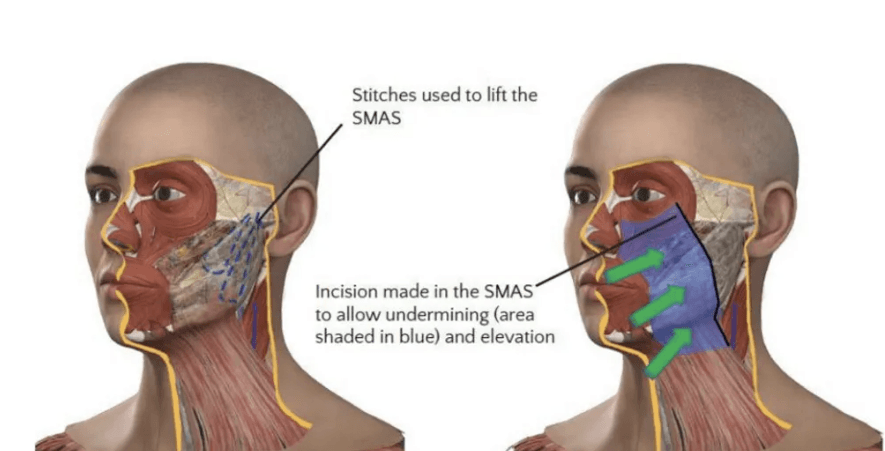 A facelift at 28? Why young people are turning to plastic surgery